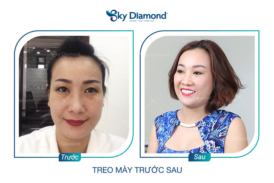 Khách hàng sau khi thực hiện treo mày E-har